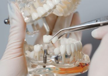 implant zębowy – Saskie Centrum Zdrowia i Odnowy